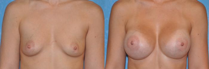 Before & After Breast Augmentation Case 258 View #1 View in Toledo, Ohio