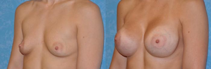 Before & After Breast Augmentation Case 258 View #3 View in Toledo, Ohio