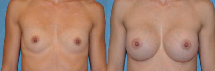 Before & After Breast Augmentation Case 259 View #1 View in Toledo, Ohio