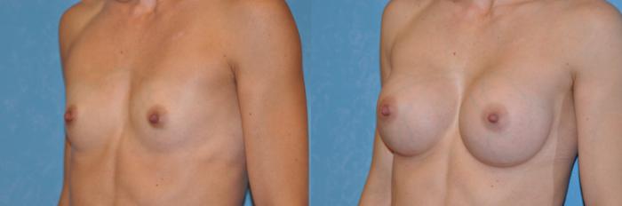Before & After Breast Augmentation Case 259 View #3 View in Toledo, Ohio
