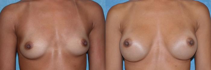 Before & After Breast Augmentation Case 26 View #2 View in Toledo, Ohio