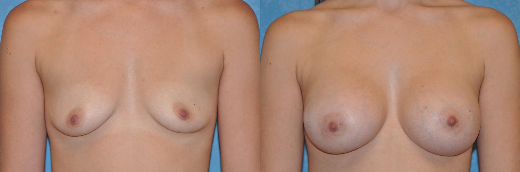 Before & After Breast Augmentation Case 261 View #1 View in Toledo, Ohio