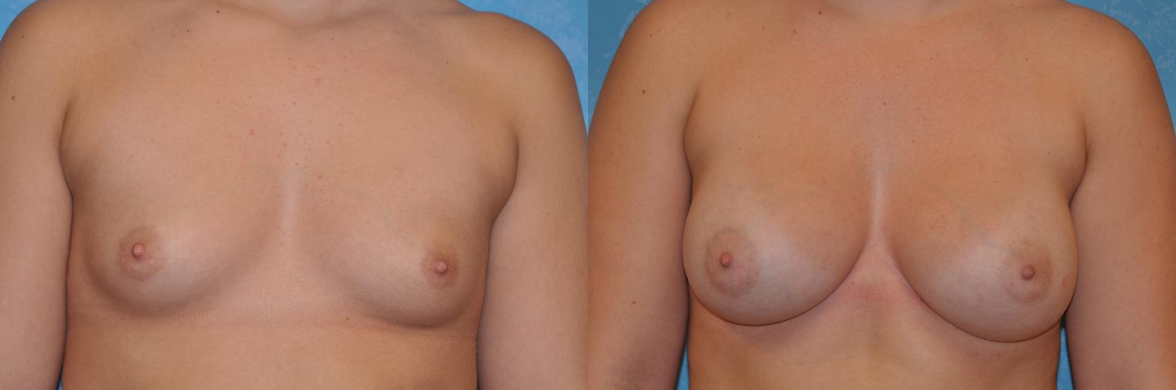Before & After Breast Augmentation Case 263 View #1 View in Toledo, Ohio