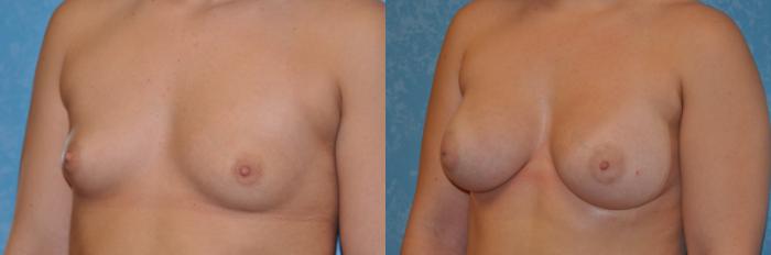 Before & After Breast Augmentation Case 263 View #2 View in Toledo, Ohio