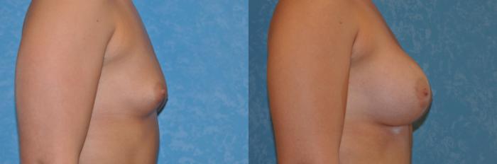 Before & After Breast Augmentation Case 263 View #3 View in Toledo, Ohio