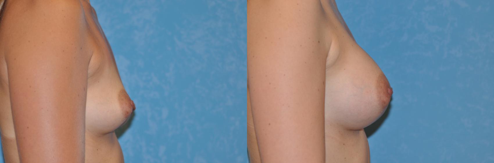 Before & After Breast Augmentation Case 267 View #1 View in Toledo, Ohio
