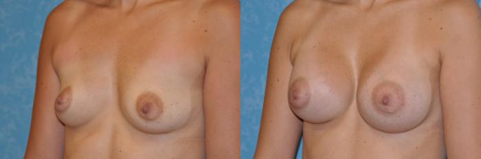 Before & After Breast Augmentation Case 267 View #2 View in Toledo, Ohio