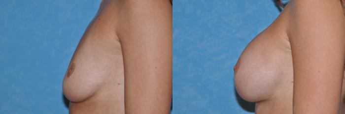 Before & After Breast Augmentation Case 27 View #2 View in Toledo, Ohio