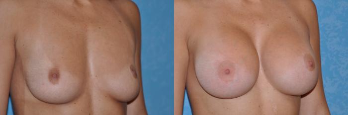 Before & After Breast Augmentation Case 27 View #3 View in Toledo, Ohio