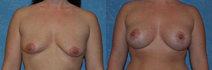 Before & After Breast Augmentation Case 277 View #1 View in Toledo, Ohio