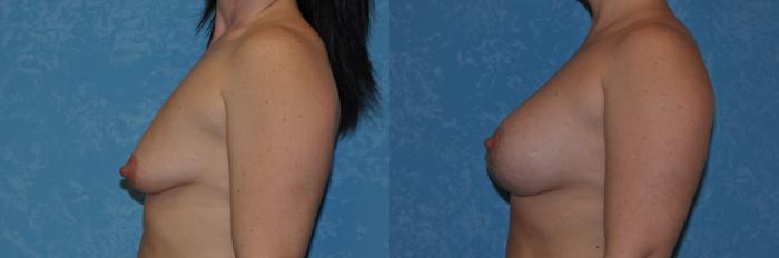 Before & After Breast Augmentation Case 277 View #2 View in Toledo, Ohio
