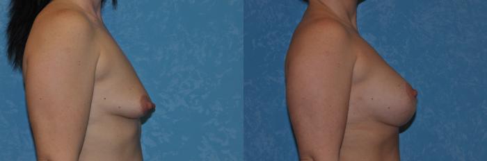 Before & After Breast Augmentation Case 277 View #3 View in Toledo, Ohio