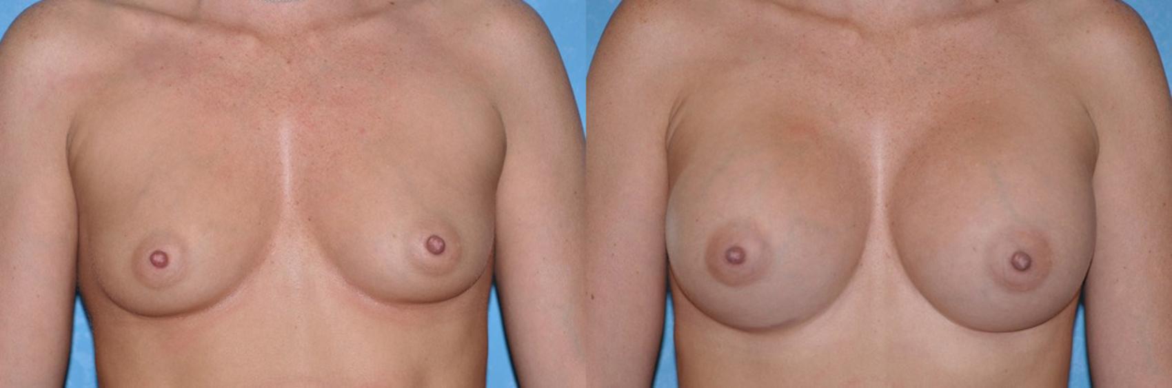 Before & After Breast Augmentation Case 28 View #1 View in Toledo, Ohio