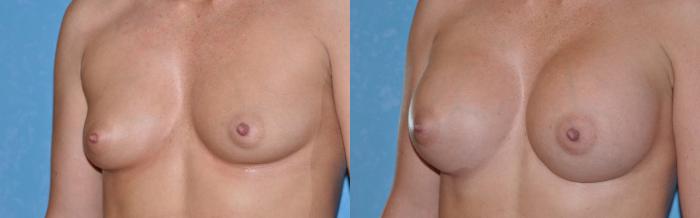 Before & After Breast Augmentation Case 28 View #2 View in Toledo, Ohio