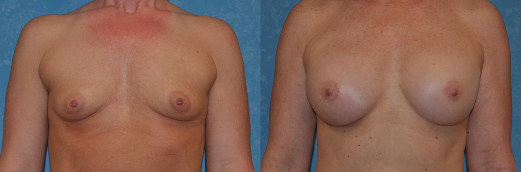 Before & After Breast Augmentation Case 282 View #1 View in Toledo, Ohio