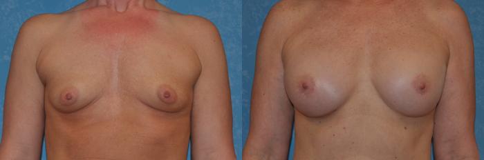 Before & After Breast Augmentation Case 282 View #1 View in Toledo, Ohio