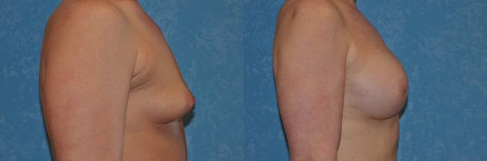 Before & After Breast Augmentation Case 282 View #2 View in Toledo, Ohio