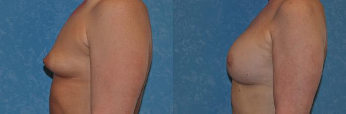 Before & After Breast Augmentation Case 282 View #3 View in Toledo, Ohio