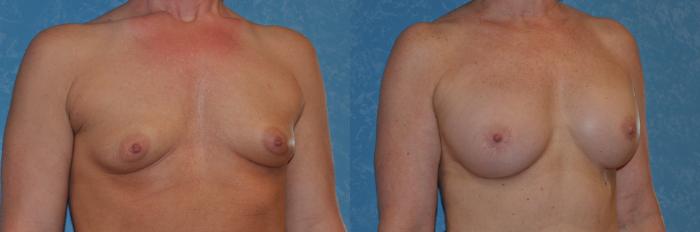Before & After Breast Augmentation Case 282 View #4 View in Toledo, Ohio