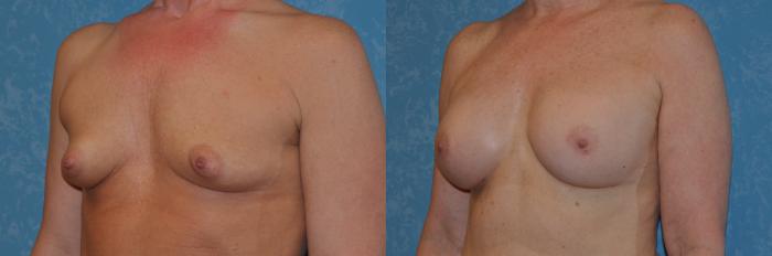 Before & After Breast Augmentation Case 282 View #5 View in Toledo, Ohio