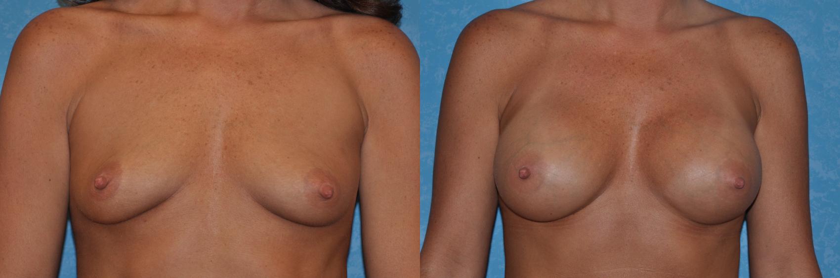 Before & After Breast Augmentation Case 283 View #1 View in Toledo, Ohio