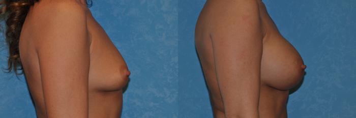 Before & After Breast Augmentation Case 283 View #2 View in Toledo, Ohio