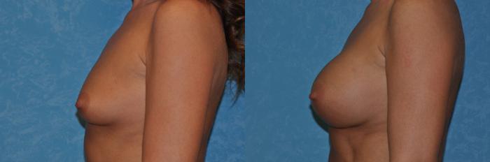 Before & After Breast Augmentation Case 283 View #3 View in Toledo, Ohio