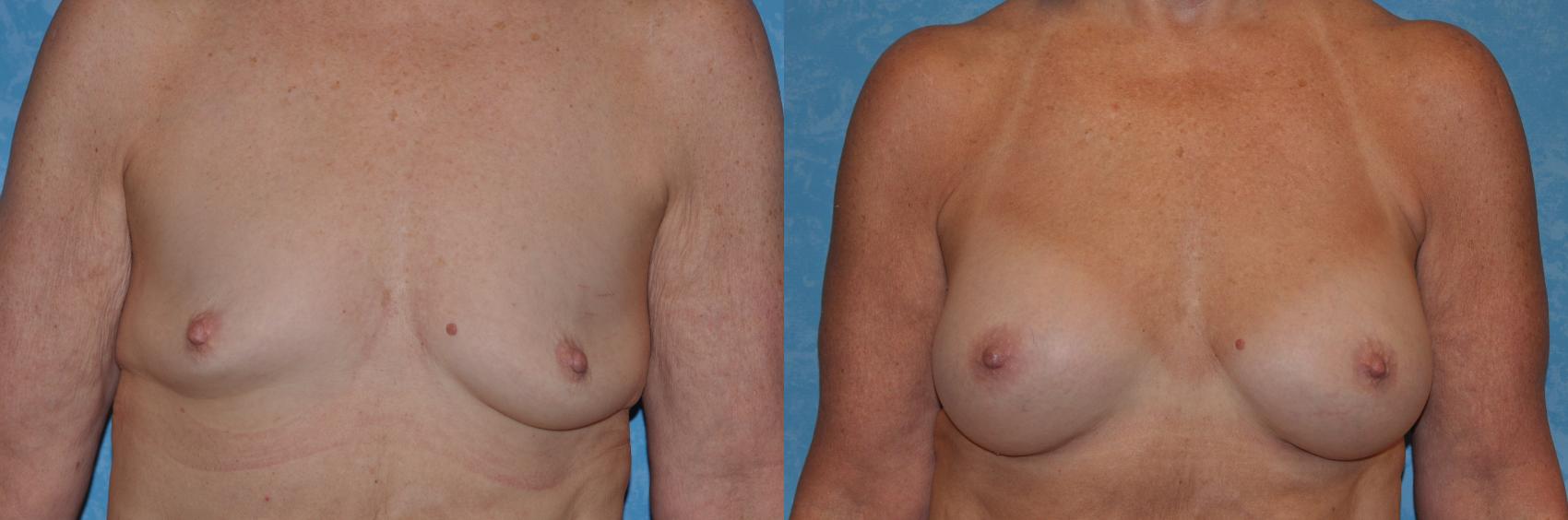 Before & After Breast Augmentation Case 294 View #1 View in Toledo, Ohio