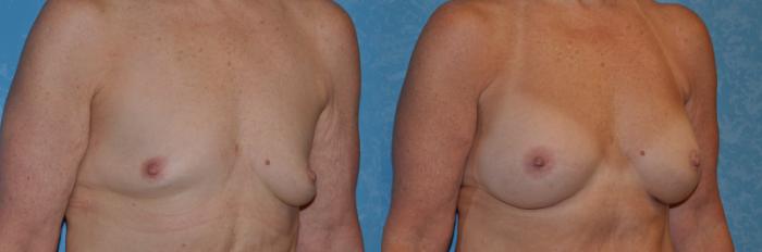 Before & After Breast Augmentation Case 294 View #2 View in Toledo, Ohio