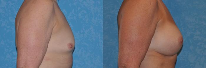 Before & After Breast Augmentation Case 294 View #3 View in Toledo, Ohio