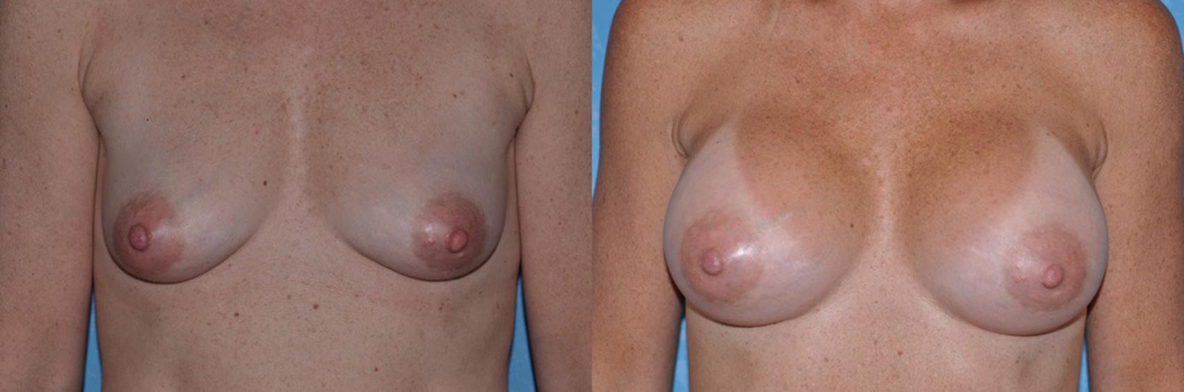 Before & After Breast Augmentation Case 30 View #1 View in Toledo, Ohio