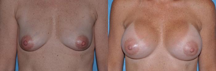 Before & After Breast Augmentation Case 30 View #1 View in Toledo, Ohio