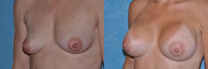 Before & After Breast Augmentation Case 30 View #2 View in Toledo, Ohio