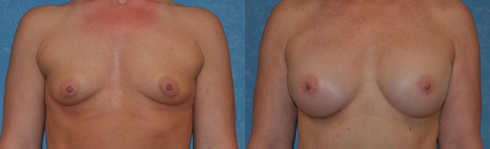 Before & After Breast Augmentation Case 304 View #1 View in Toledo, Ohio