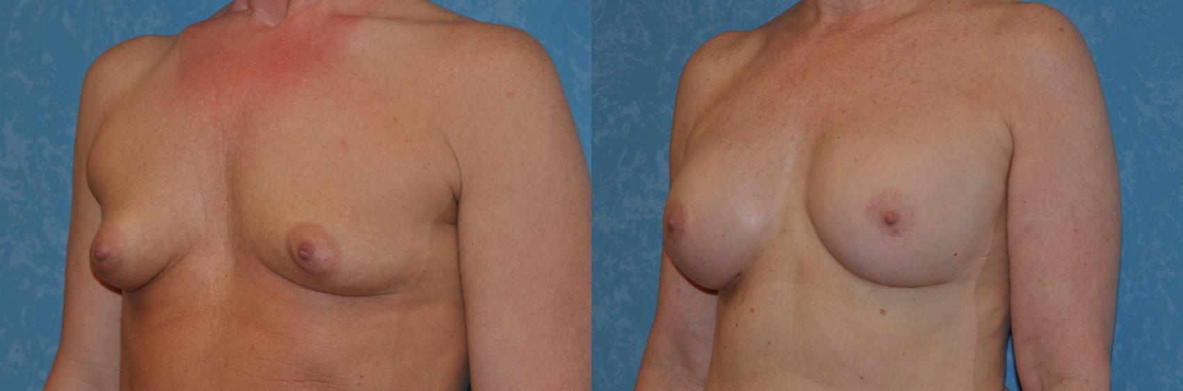 Before & After Breast Augmentation Case 304 View #2 View in Toledo, Ohio