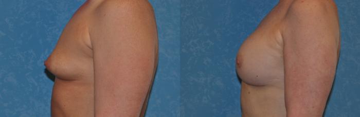 Before & After Breast Augmentation Case 304 View #3 View in Toledo, Ohio