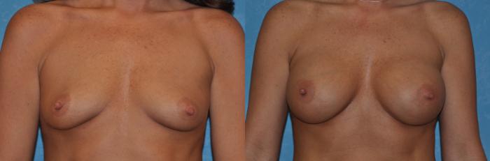Before & After Breast Augmentation Case 305 View #1 View in Toledo, Ohio