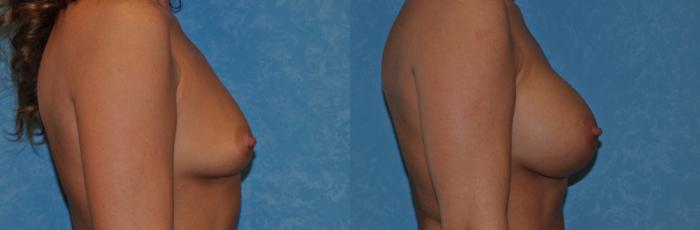 Before & After Breast Augmentation Case 305 View #2 View in Toledo, Ohio
