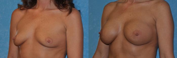 Before & After Breast Augmentation Case 305 View #3 View in Toledo, Ohio