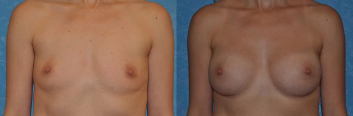 Before & After Breast Augmentation Case 306 View #1 View in Toledo, Ohio