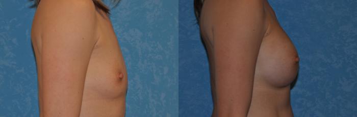 Before & After Breast Augmentation Case 306 View #2 View in Toledo, Ohio