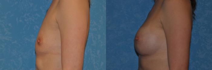 Before & After Breast Augmentation Case 306 View #3 View in Toledo, Ohio