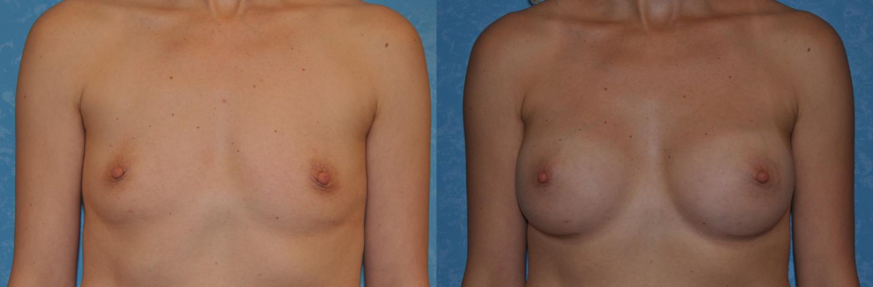 Before & After Breast Augmentation Case 307 View #1 View in Toledo, Ohio