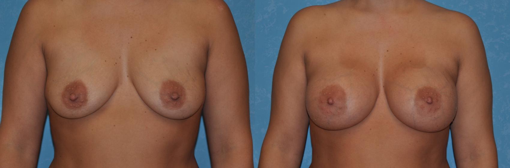 Before & After Breast Augmentation Case 308 View #1 View in Toledo, Ohio