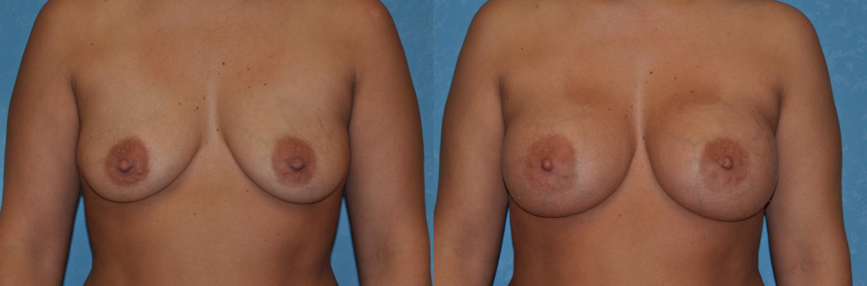 Before & After Breast Augmentation Case 308 View #1 View in Toledo, Ohio