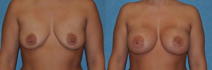 Before & After Breast Augmentation Case 308 View #1 View in Toledo, Ohio