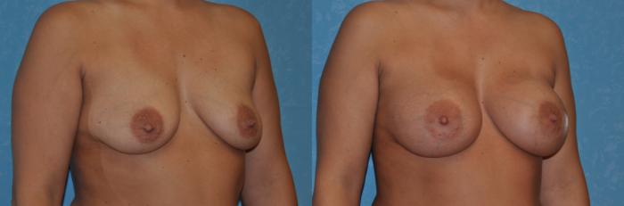 Before & After Breast Augmentation Case 308 View #2 View in Toledo, Ohio