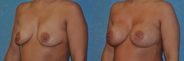 Before & After Breast Augmentation Case 308 View #3 View in Toledo, Ohio