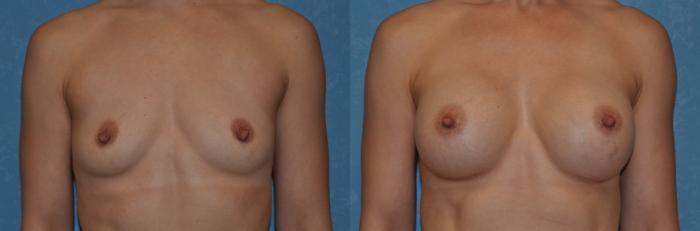 Before & After Breast Augmentation Case 310 View #1 View in Toledo, Ohio