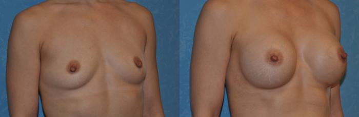Before & After Breast Augmentation Case 310 View #2 View in Toledo, Ohio